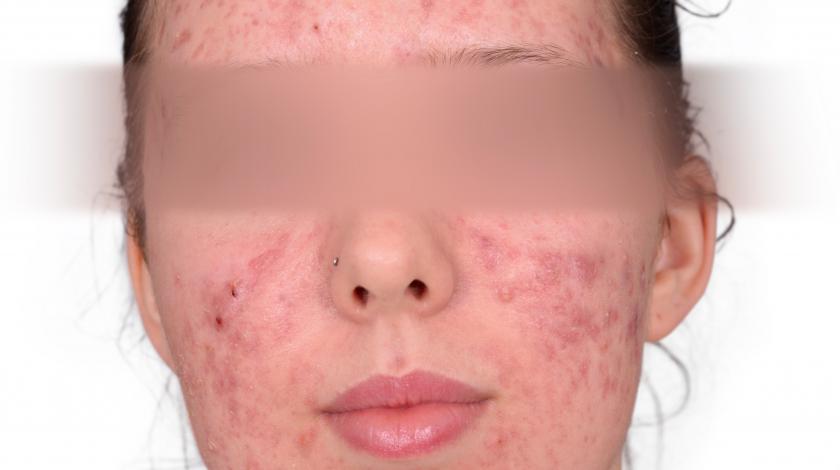 ICLID PRE trattamento ACNE