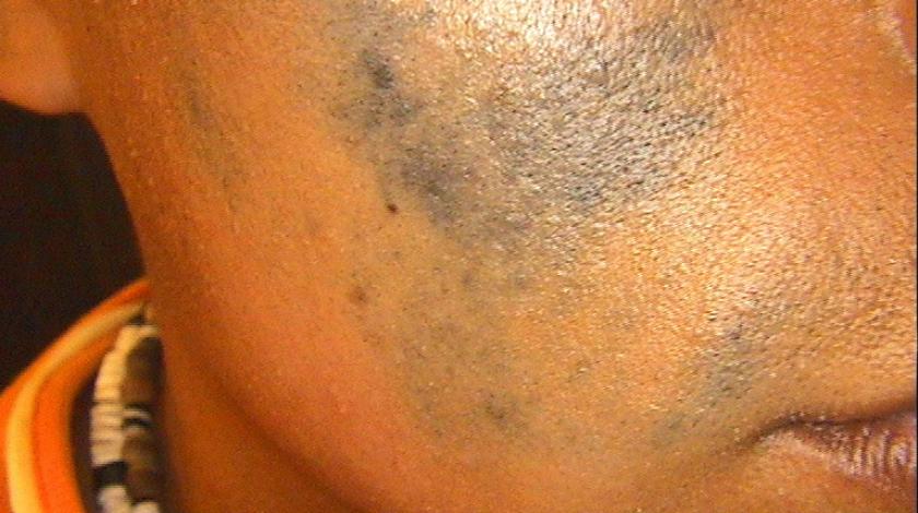 ICLID laserterapia nevo ota pre