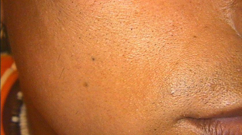 ICLID laserterapia nevo ota post