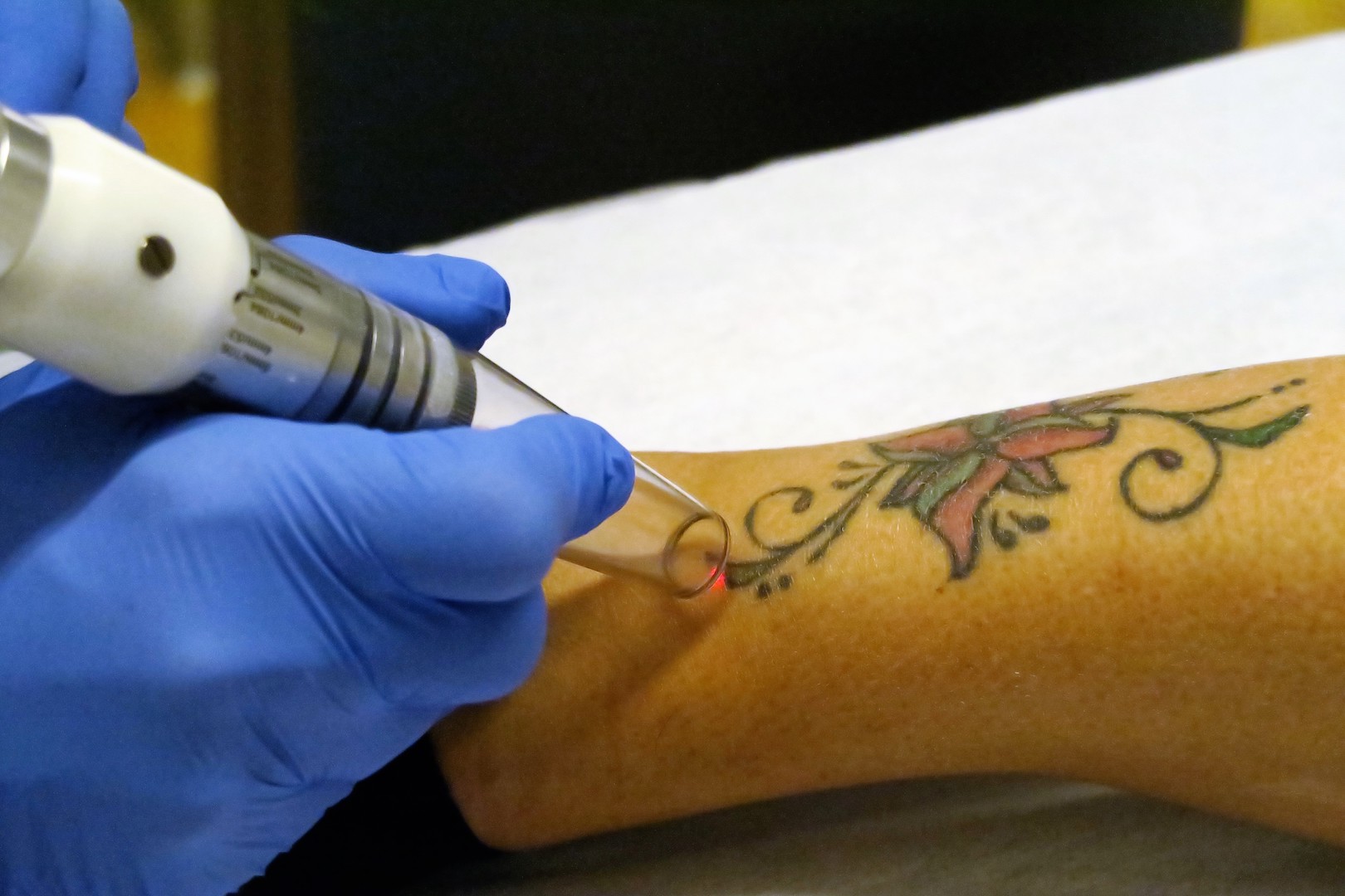 Rimuovere i tatuaggi: Le tecniche ed i procedimenti necessari.