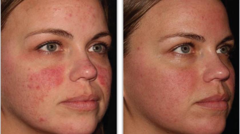 ICLID halo pre post 1