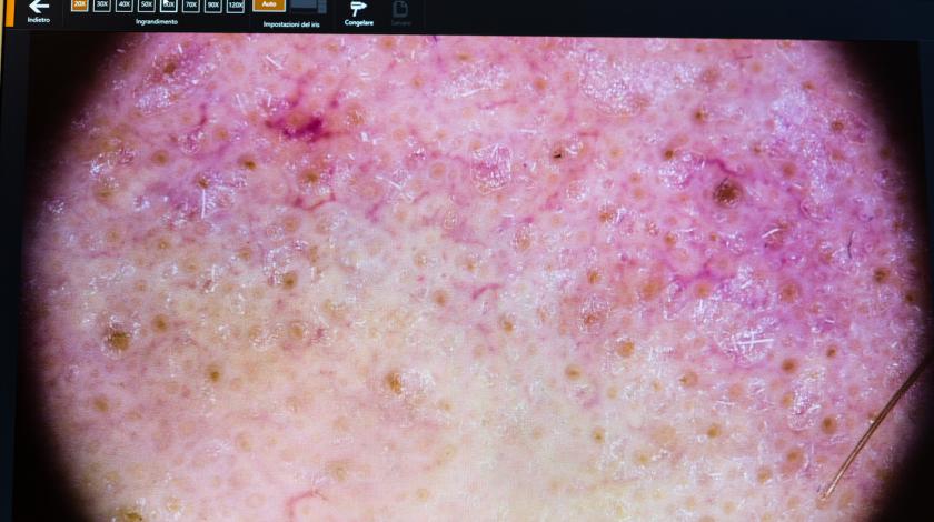 capillaroscopia digitale micro