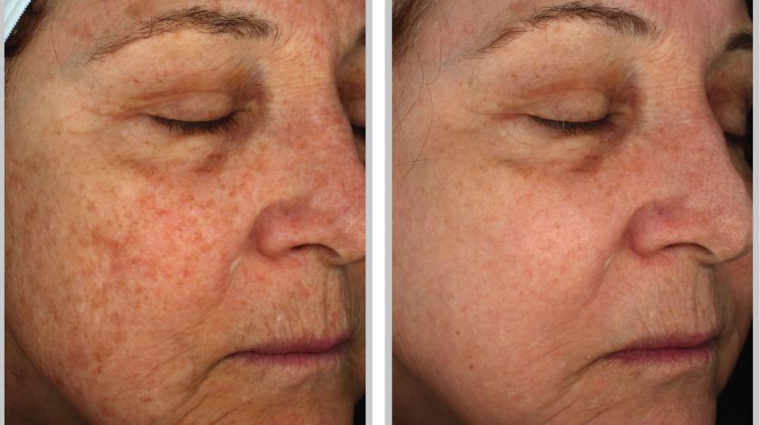 ICLID Halo pre post 3