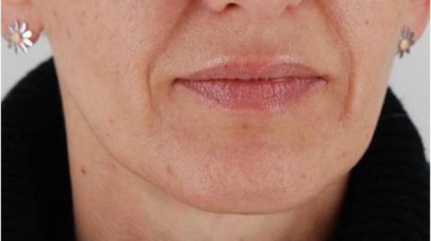 acido polilattilo post