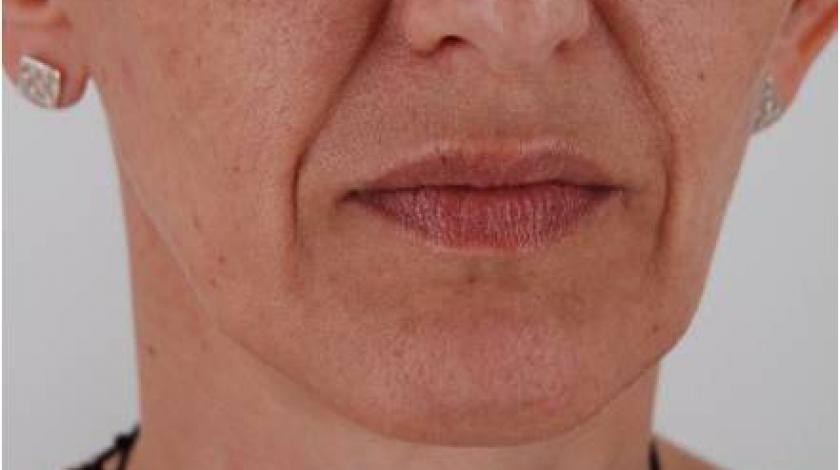 acido polilattilo pre