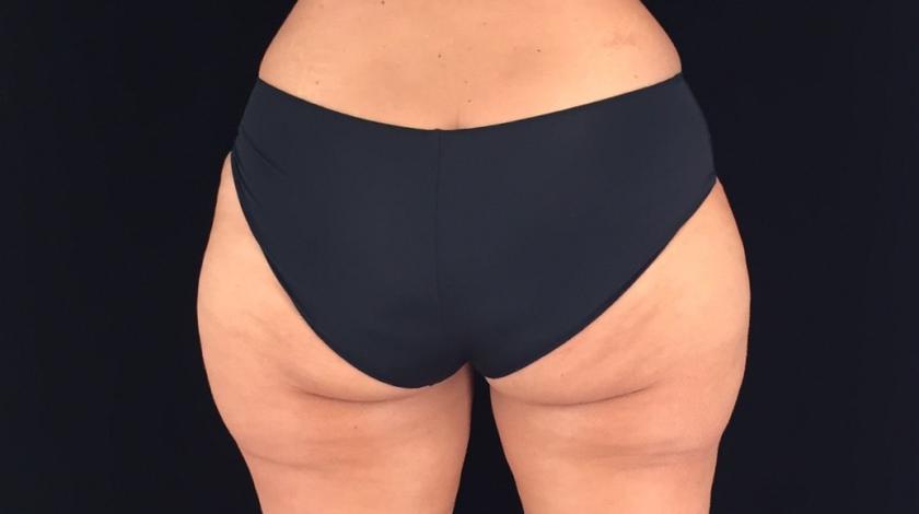 adiposità localizzata