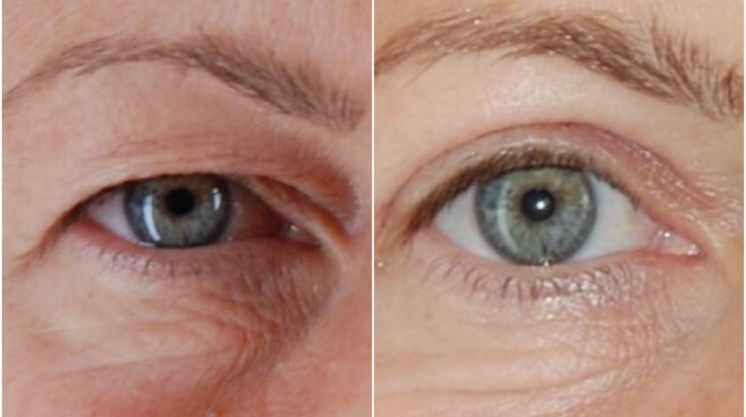 blefarolastica PRE POST