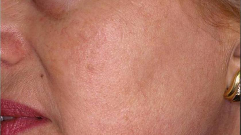 post trattamento laser capillari viso