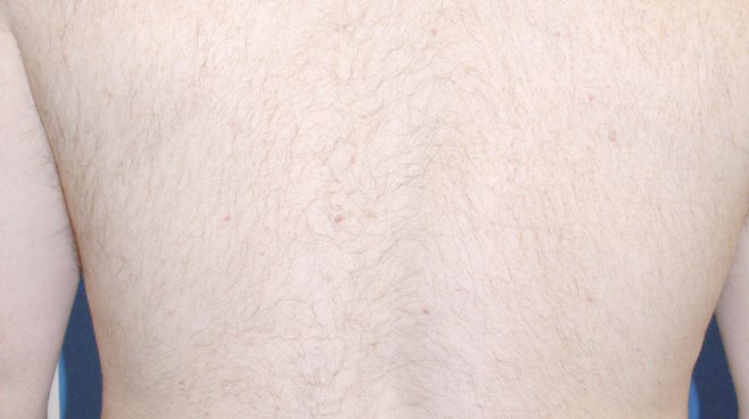 ICLID depilazione laser POST