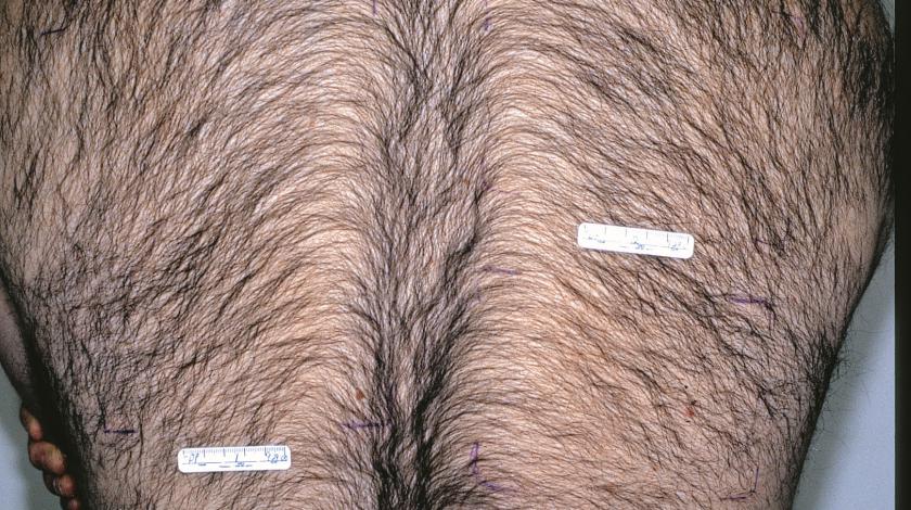 ICLID depilazione laser PRE