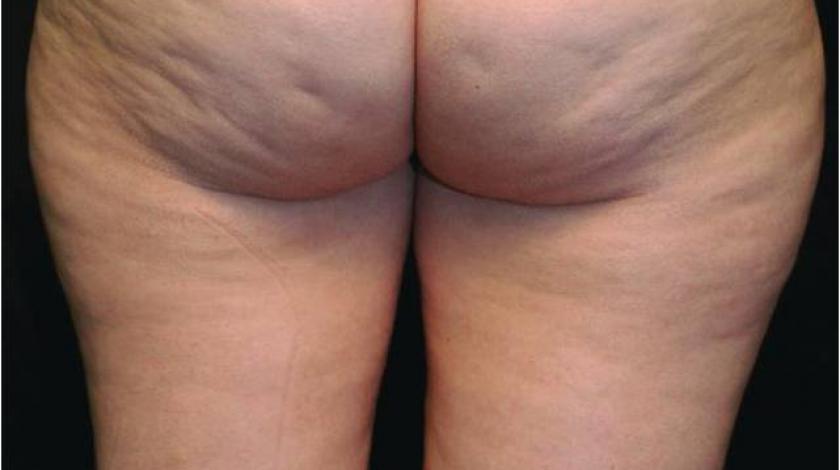 cellulite