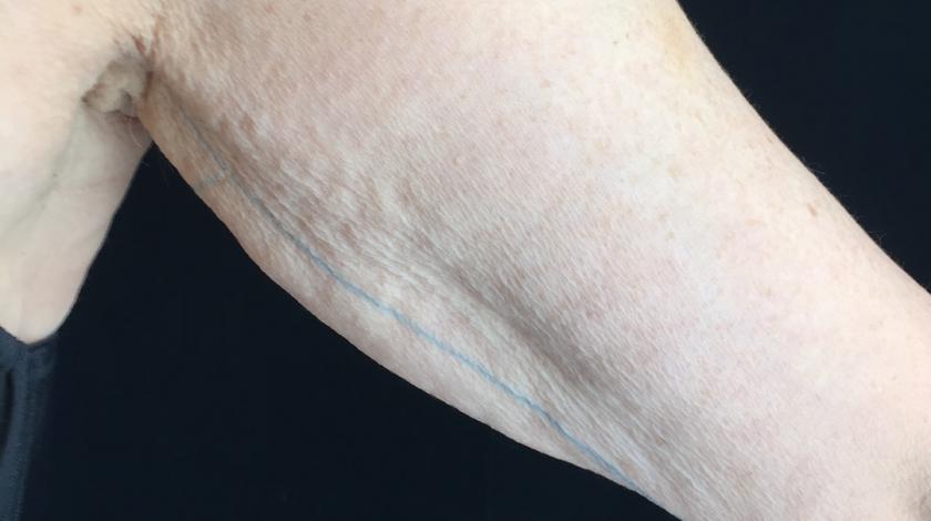 invecchiamento braccia