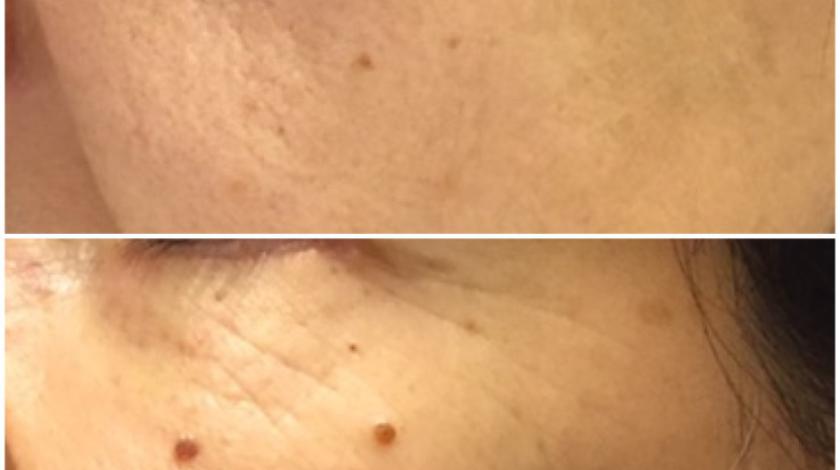 lipofilling