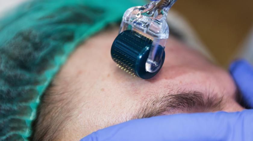 needling O BIO-STIMOLAZIONE  MECCANICA  DELLA PELLE