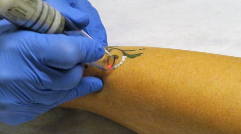 rimozione tatuaggi laser