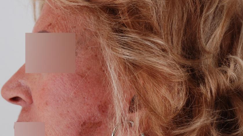 ringiovanimento laser 2 pre