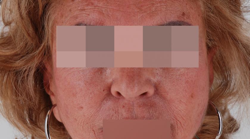 ringiovanimento laser PRE