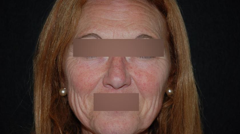 rosacea post