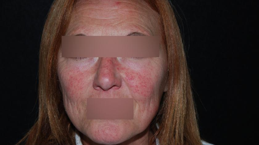 rosacea pre laser