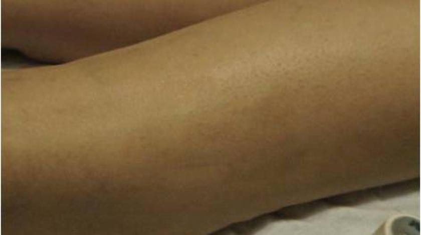 sclerterapia capillari gambe post