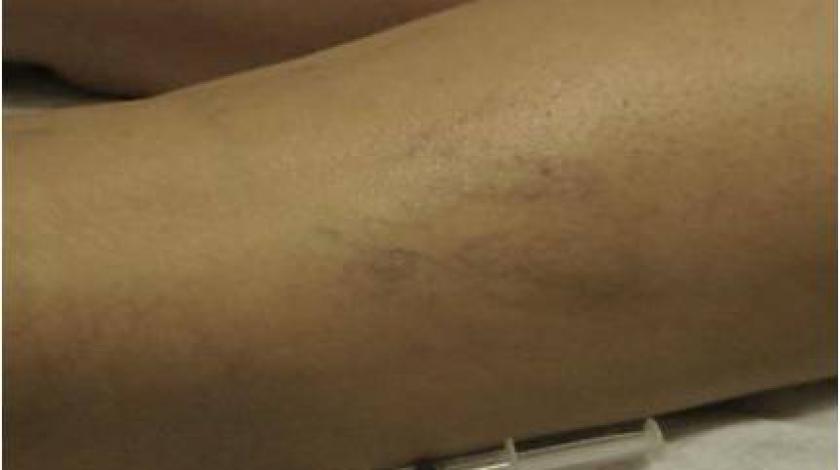 scleroterapia capillari gambe pre