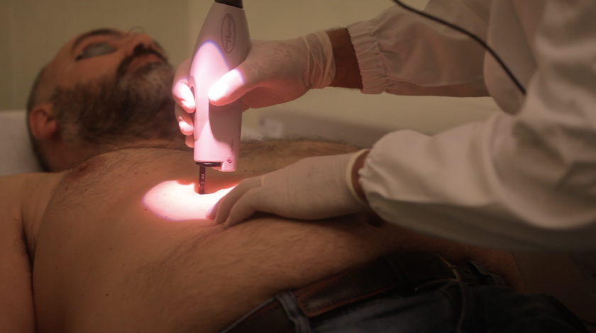 ICLID trattamento Dye laser