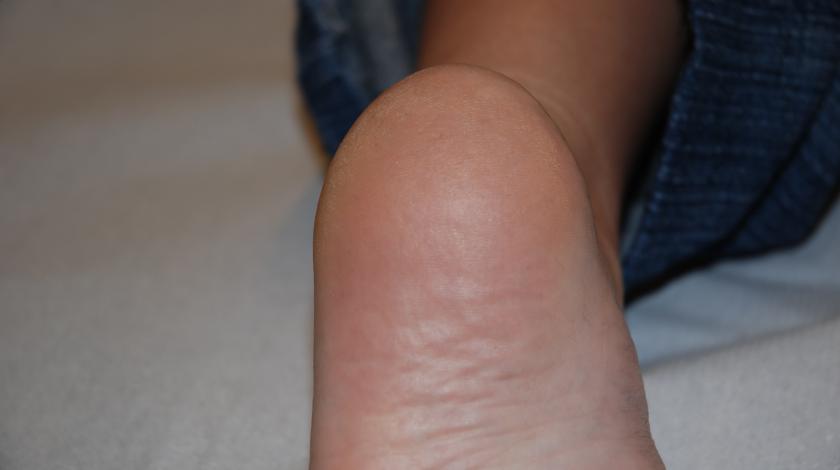 ICLID POST trattamento Verruca 2