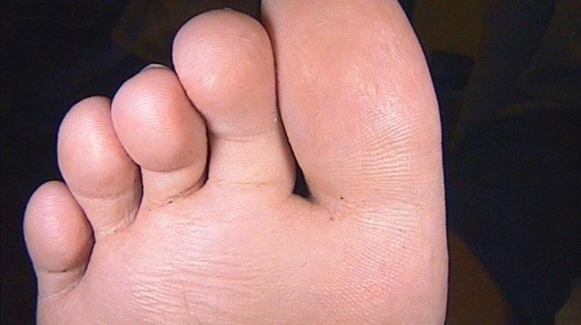 ICLID POST trattamento Verruca