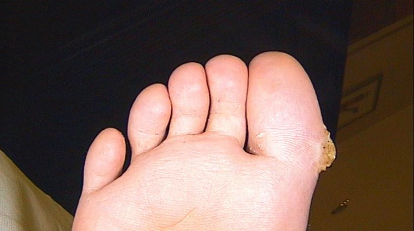 ICLID PRE trattamento Verruca