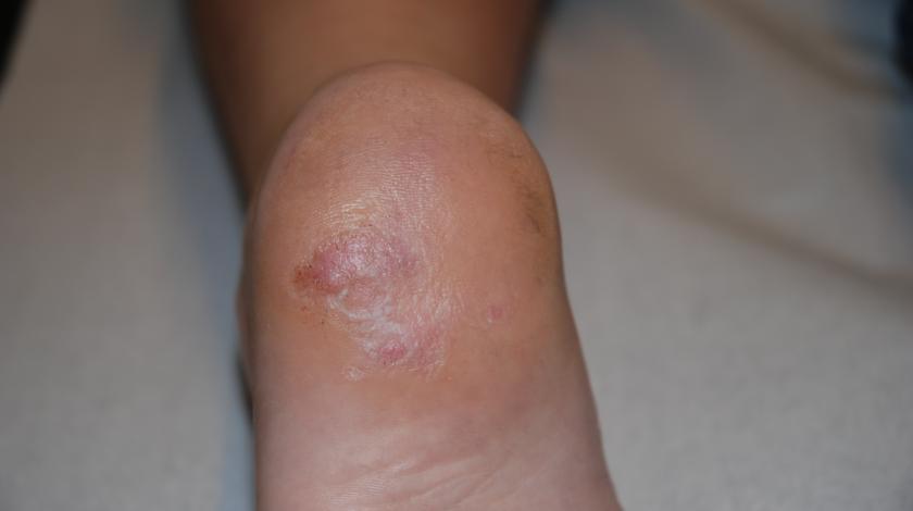 ICLID PRE trattamento Verruca 2