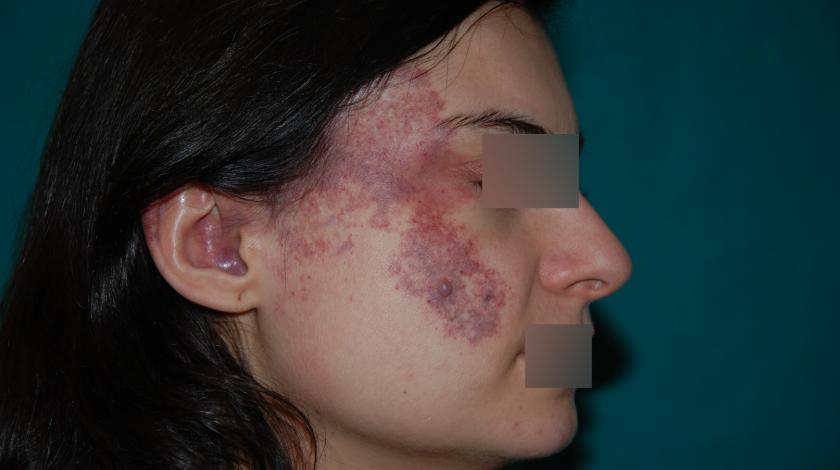 ICLID angioma piano PRE