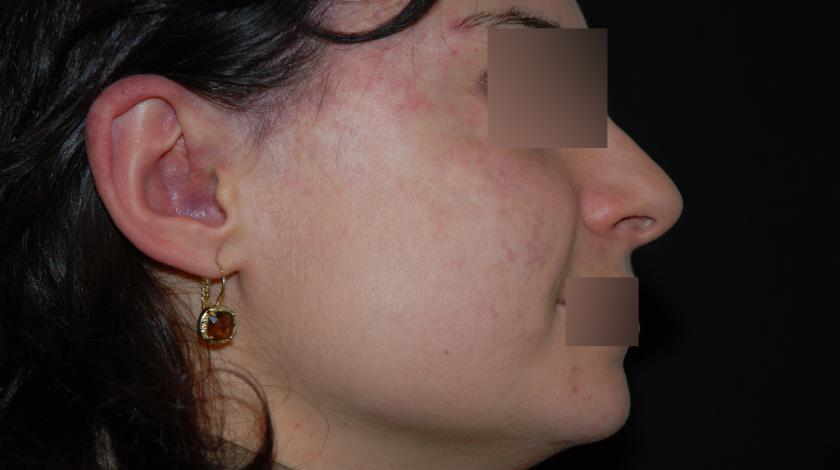 ICLID angioma piano POST