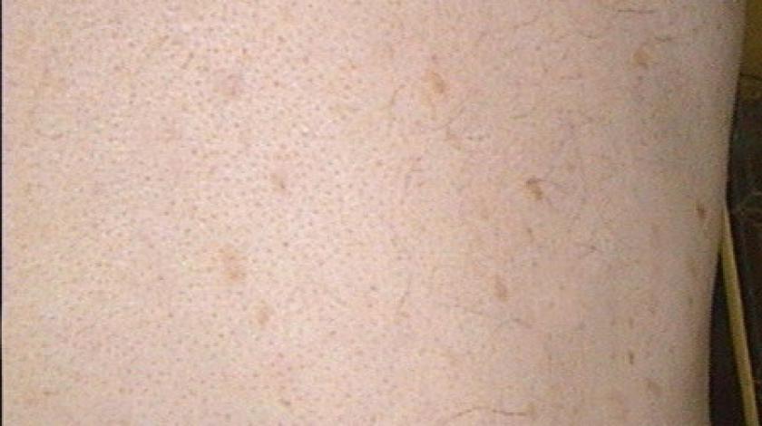 cheratosi seborroica terapia