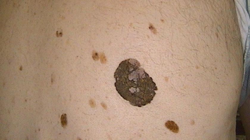 cheratosi seborroica PRE