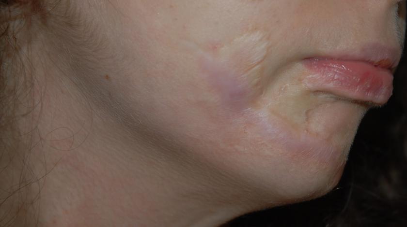 rimozione cicatrice viso POST