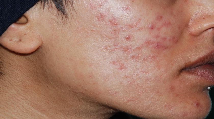 cicatrici ACNE pre