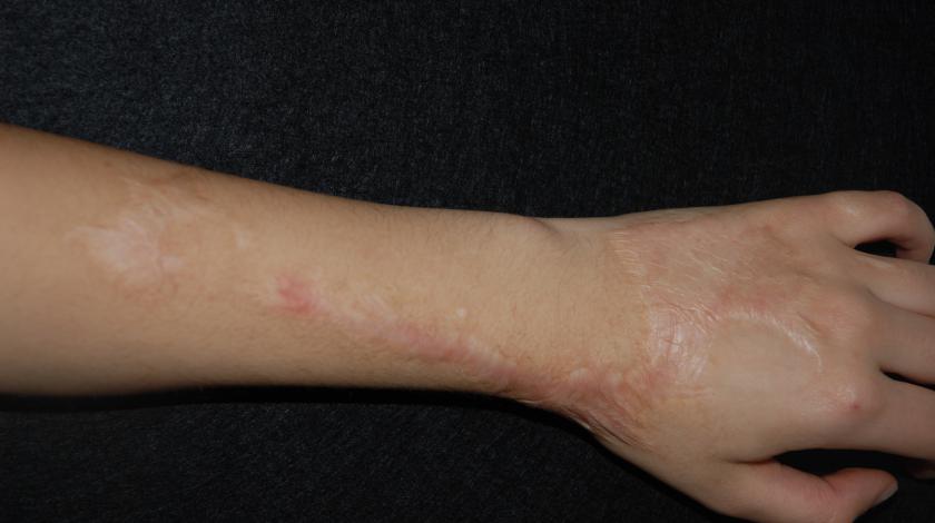 ICLID cicatrice braccio POST