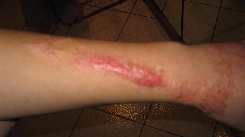 cicatrice braccio PRE