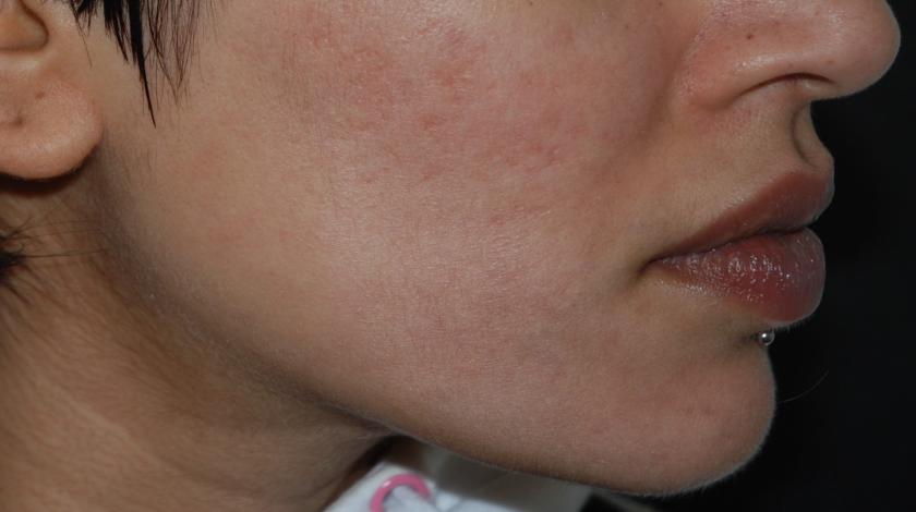 cicatrici ACNE post