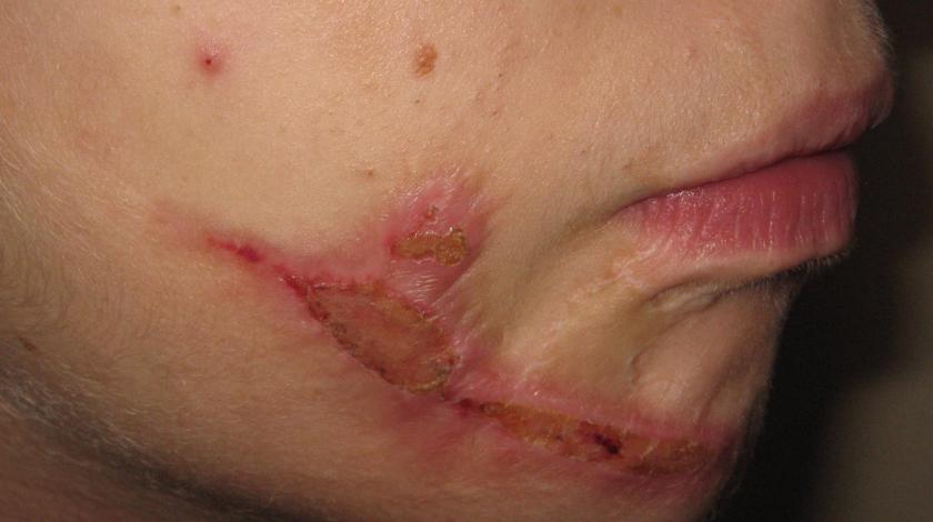 rimozione cicatrice viso PRE