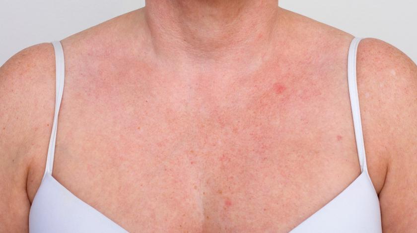 ICLID fotodanneggiamento nordlys SWT_PRE