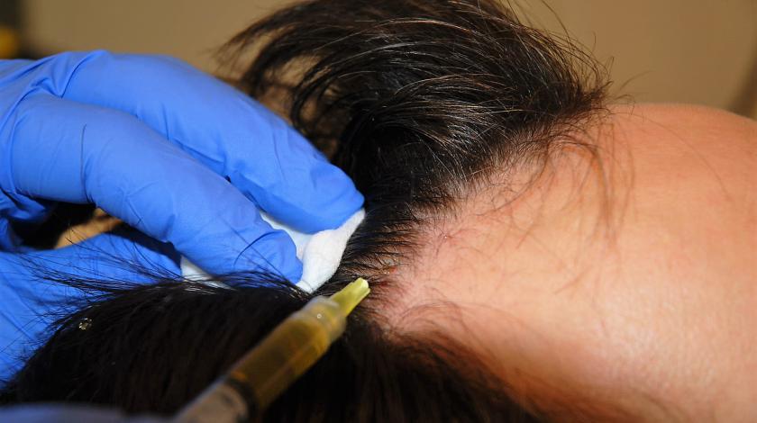 alopecia tecnica PRP