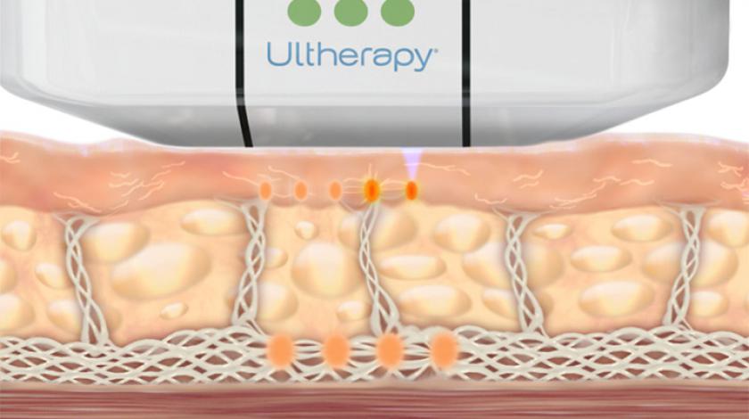 Ultherapy®  trattamento ICLID