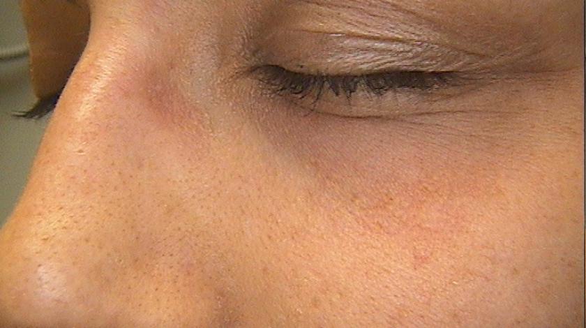 ICLID laserterapia angiomi comuni  POST
