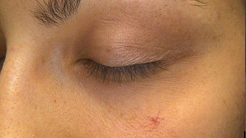 ICLID laserterapia angiomi comuni PRE