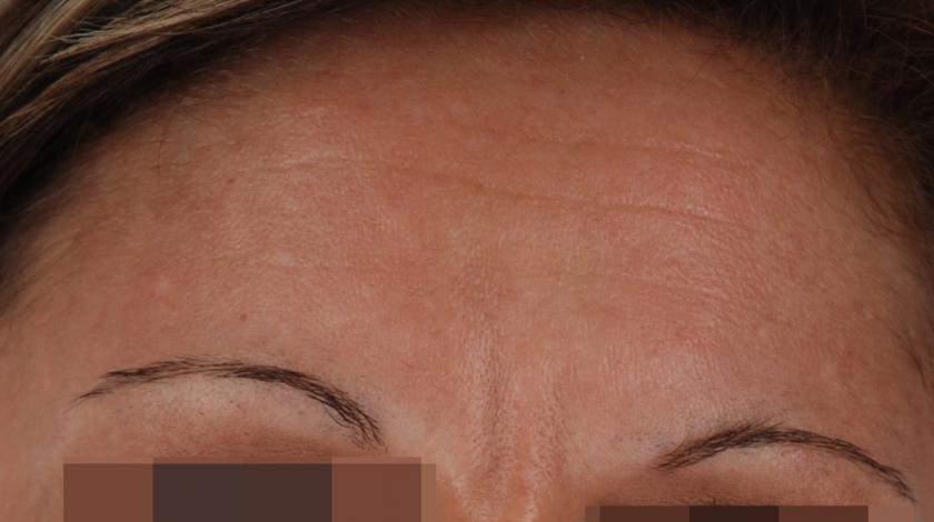 ICLID melasma POST