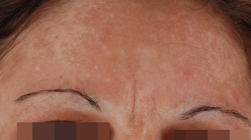 ICLID melasma PRE