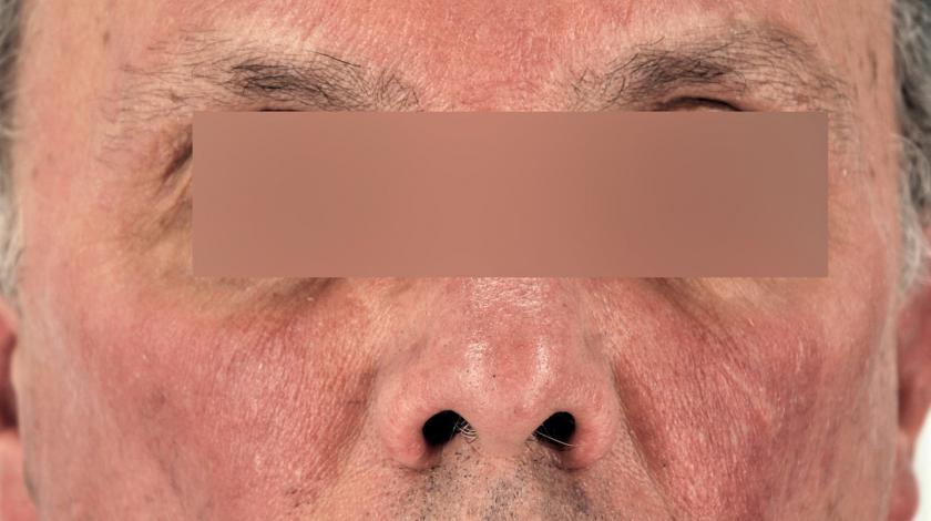 ICLID rosacea POST