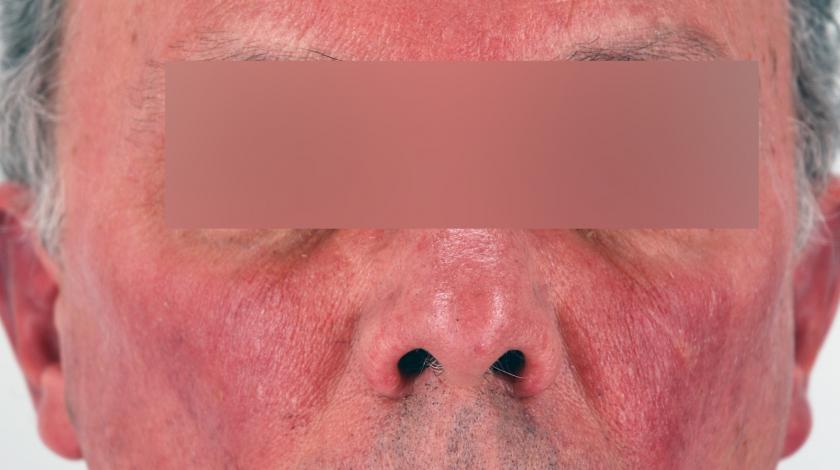 ICLID rosacea PRE