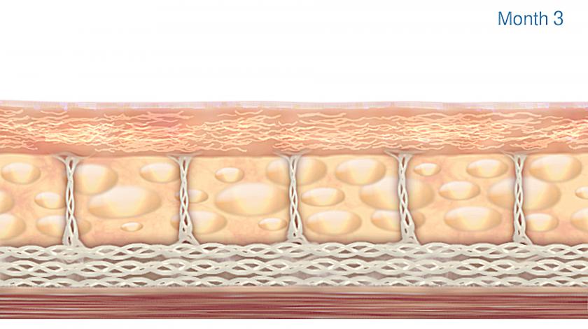 Ultherapy®  risultati dopo 3 mesi ICLID